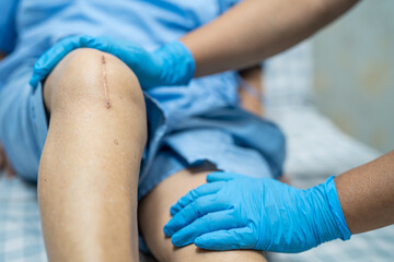 Asian senior or elderly old lady woman patient show her scars surgical total knee joint replacement...