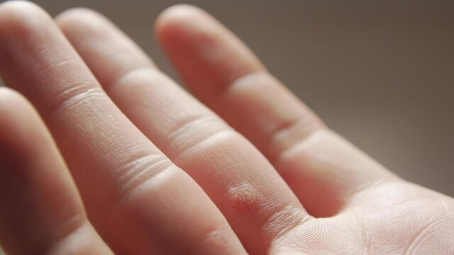The dermatology wart on fingers man hand skin closeup