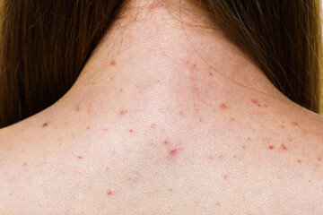 Fototapeta premium Woman with skin problem acne on back