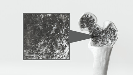 Osteoporosis stage 3 of 3 -- 3d rendering