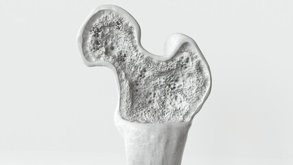 Fototapeta na wymiar Osteoporosis stage 1 of 3 -- 3d rendering