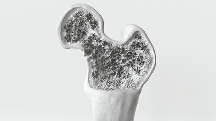 Osteoporosis stage 2 of 3 -- 3d rendering