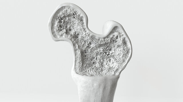 Osteoporosis stage 1 of 3 -- 3d rendering