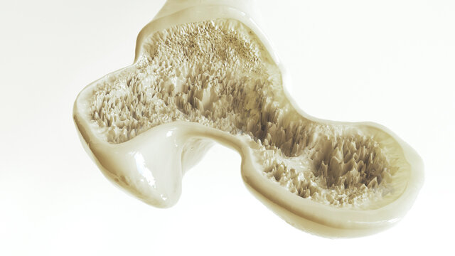 Osteoporosis stage 3 of 3 -- 3d rendering
