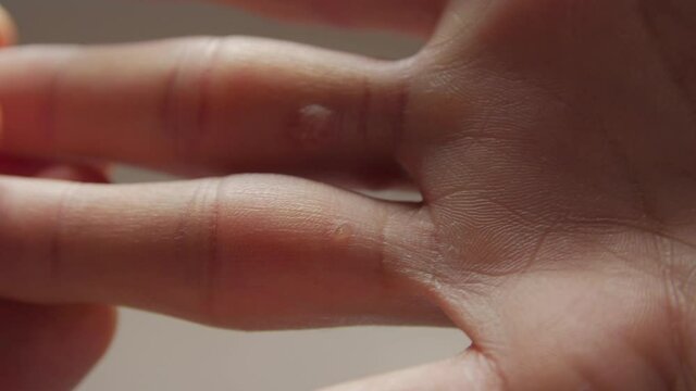 Warts on fingers man skin closeup