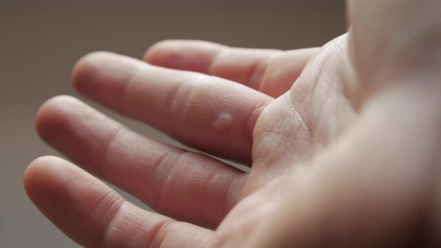 Dermatology warts hand fingers man skin closeup refocusing