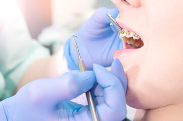 Orthodontist checking the dental braces close up