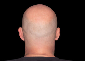 Rear view of a bald head. Adult with alopecia or hair loss. Adult man head view isolated on white...