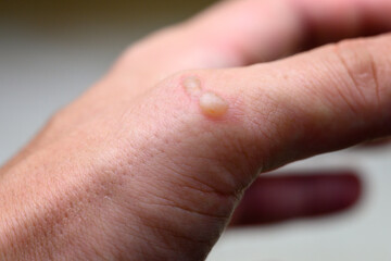 Blister on the back of a place from burns.