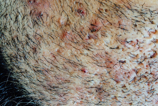 Close up of caucasian skin with many ingrown hairs. Facial skin of an adult male with inflamed pus pimples, skin holes and scars.
