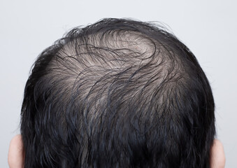 Close up man's head with hair loss, thinning hair or alopecia isolated on white background. Hair...