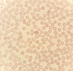 Under 100X light microscope, human parasite on thin film of blood smear with Plasmodium vivax trophozoite form malaria infected red blood cell, selective focus.