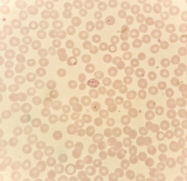 Under 100X light microscope, human parasite on thin film of blood smear with Plasmodium vivax trophozoite form malaria infected red blood cell, selective focus.