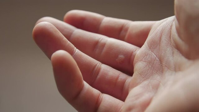 The skin lesions warts on hand closeup refocusing