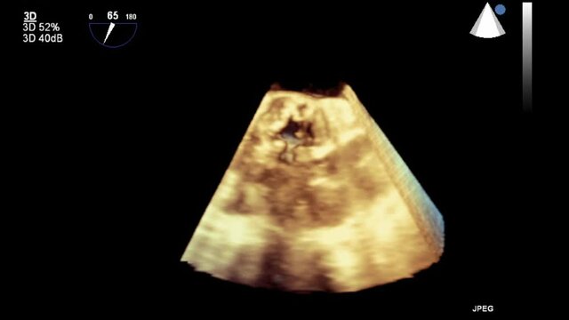 Transesophageal ultrasound video in 3D mode.