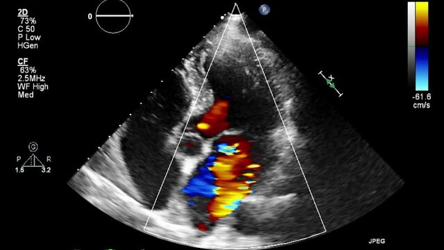 Transesophageal ultrasound video in Doppler mode.