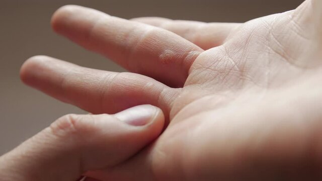Medical examination by a dermatologist warts on hand closeup
