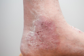 Psoriasis: patient's leg affected by psoriasis: wounds, scales, rashes, dry skin