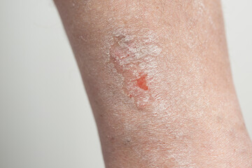 Fototapeta premium Psoriasis: the area of the patient's lower leg affected by psoriasis