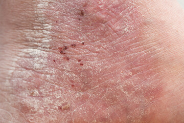 Psoriasis: close-up of the back of a patient affected by psoriasis