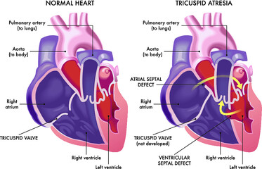 Medical illustration that compare a normal heart with a heart affected by cardiac defect called Tricuspid Atresia, with annotations.