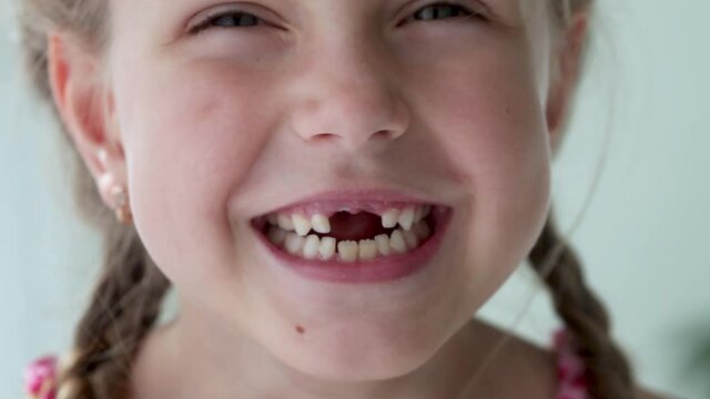 Close-up smile of a girl. A beautiful little girl 7 years old has lost milk teeth. Loss of milk teeth, replacement of permanent teeth. Children's dentistry.