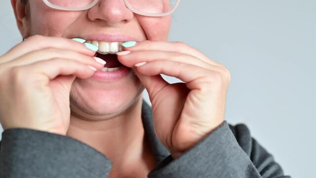 Close-up of a woman putting on transparent plastic retainers. The girl uses a device to straighten her teeth