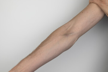 A male drug addict shows his hands and veins, which show bruises from the injections. The concept...