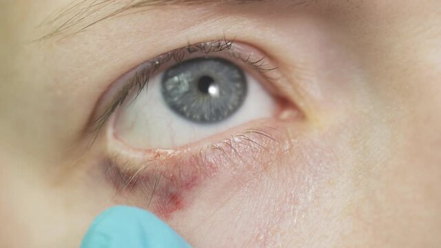 An ophthalmologist examines the eye of a patient with blepharitis. Inflammation of the eyelid, conjunctivitis
