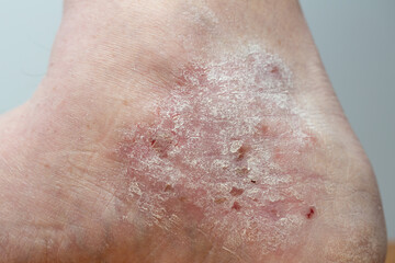 Close-up of the part of the patient's leg affected by psoriasis