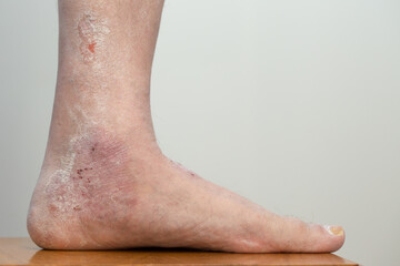 Psoriasis lesions on the lower part of the patient's leg