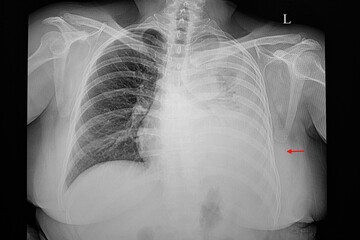 A chest xray film of a patient with massive  pleural effusion.