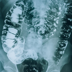 X-ray of the human intestine. Bowel diseases.