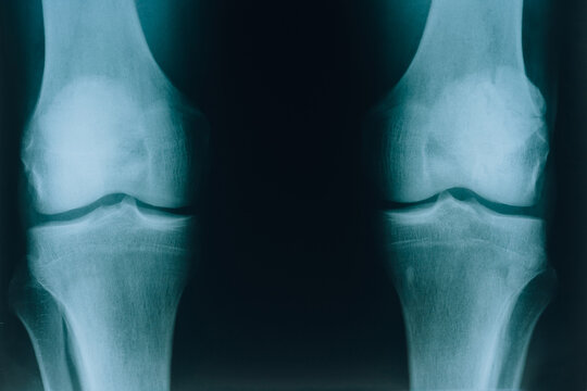 X-ray. An image of the bones and joints of the legs