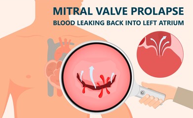 Fototapeta premium Cath Lab Atrial Septal Defect Tetralogy of Fallot Patent Foramen Ovale Mitral Valve Stenosis Heart Attack Ductus Arteriosus Doppler Coronary Artery Disease Congestive Congenital Valvular VSD exam leak