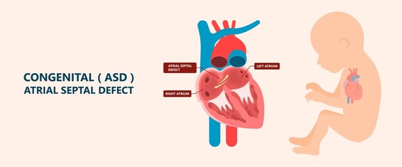Cath Lab Atrial Septal Defect Tetralogy of Fallot Patent Foramen Ovale Mitral Valve Stenosis Heart Attack Ductus Arteriosus Doppler Coronary Artery Disease Congestive Congenital Valvular VSD exam leak