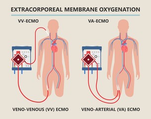 Extracorporeal membrane oxygenation ECMO a life support system for Respiratory failure patient system illness damage Infection perfusionist Ards transplant myocarditis embolism - obrazy, fototapety, plakaty