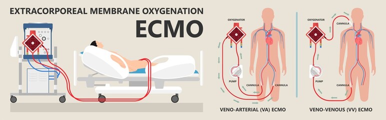 Extracorporeal membrane oxygenation ECMO a life support system for Respiratory failure patient system illness damage Infection perfusionist Ards transplant myocarditis embolism
