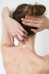 A girl with psoriasis. She can use ointments and creams to cure it and get rid of itching.