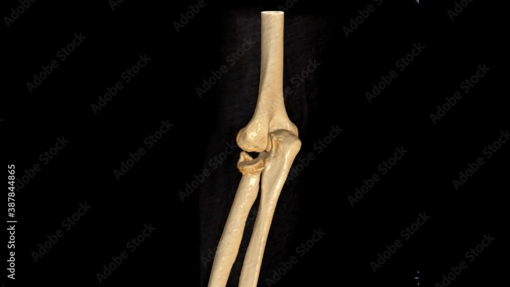 Poster ct elbow 3d rendering image showing fracture of radius bone.