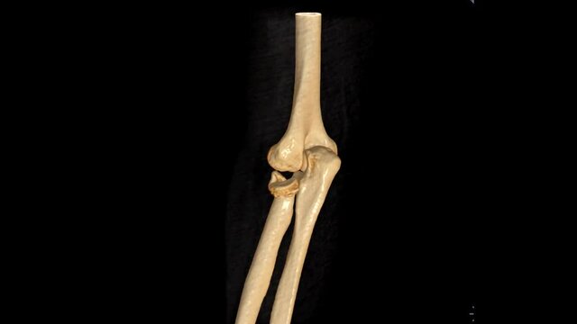 CT Elbow 3D rendering image showing fracture of radius bone.
