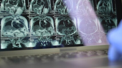 X-Ray Images Examined by Doctor in Blue Surgical Gloves on Laptop using Touchpad