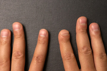 index finger after hand surgery. Damaged finger. after gangrene - obrazy, fototapety, plakaty