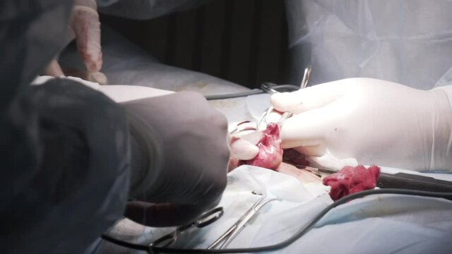 Close up of genitals of a patient who has testicular cancer. Action. Surgeons cutting out a tumor from male tescticle in the operating room in a hospital.