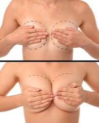 Woman with marks on her chest against white background. Concept of breast augmentation