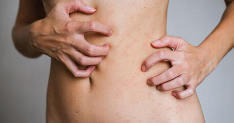 Fototapeta premium Psoriasis skin disease is a dermatic problem, red allergic skin rash.