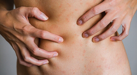 Psoriasis skin disease is a dermatic problem, red allergic skin rash.