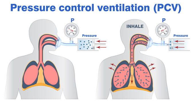 Illustration of pressure control or support artifitial ventilation. Tidal volume, mask ventilation, breathing resuscitator bag ventilation.
