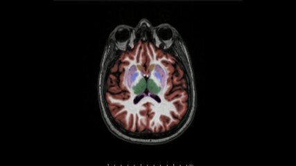 Magnetic resonance imaging of the brain in axial plane color coded sequence used for diagnosis of memory impairment and Alzheimer disease. MRI brain. Alzheimer disease.