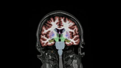 Magnetic resonance imaging of the brain in coronal plane color coded sequence used for diagnosis of memory impairment and Alzheimer disease. MRI brain. Alzheimer disease.